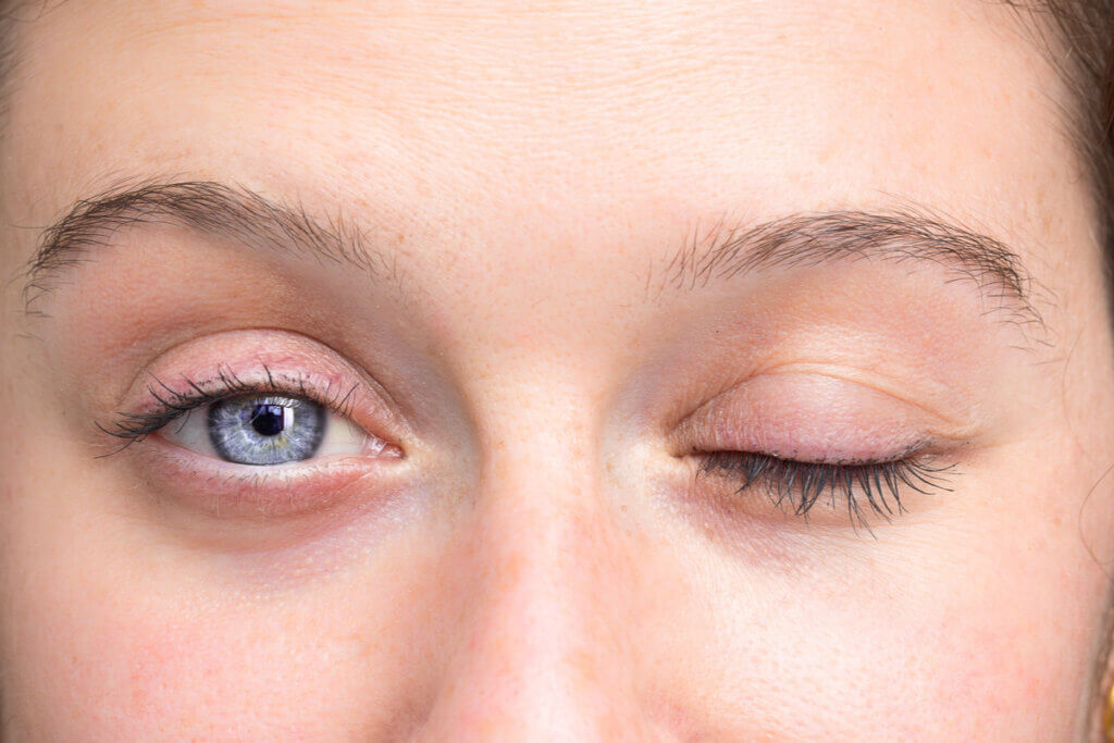 Parálisis facial.