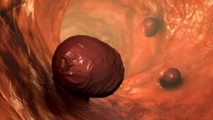 Colorectal Polyps: Everything You Need to Know