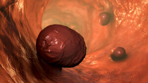 Pólipos de colon y recto: todo lo que debes saber