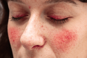 Rosacea: tutto quello che c'è da sapere