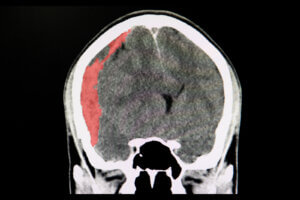 Diferencias entre ictus y derrame cerebral