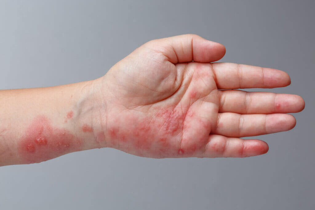 As 10 doenças da pele mais comuns