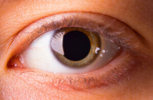 ¿Qué es la midriasis?