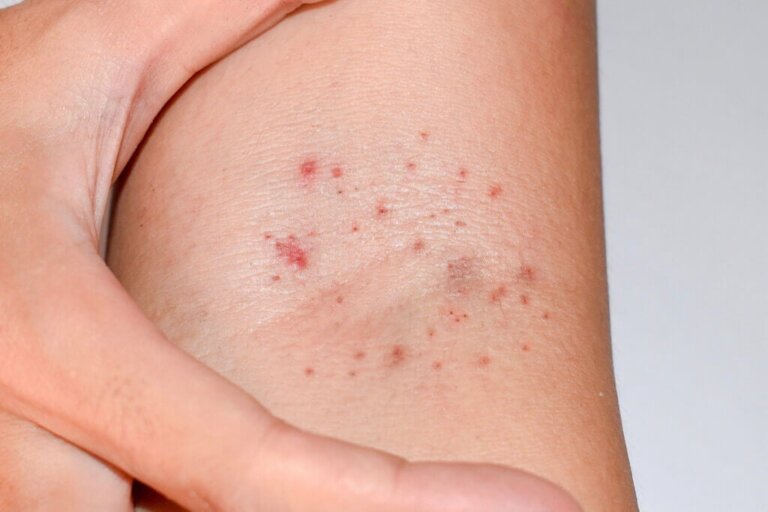 What Are Petechiae and Why Do They Appear?