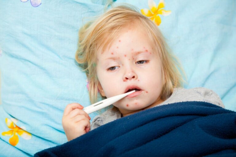 The Differences Between Measles and Chickenpox