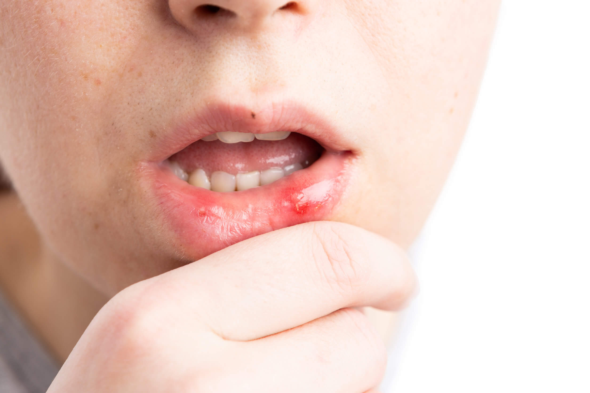To heal mouth ulcers, topical products may be required.