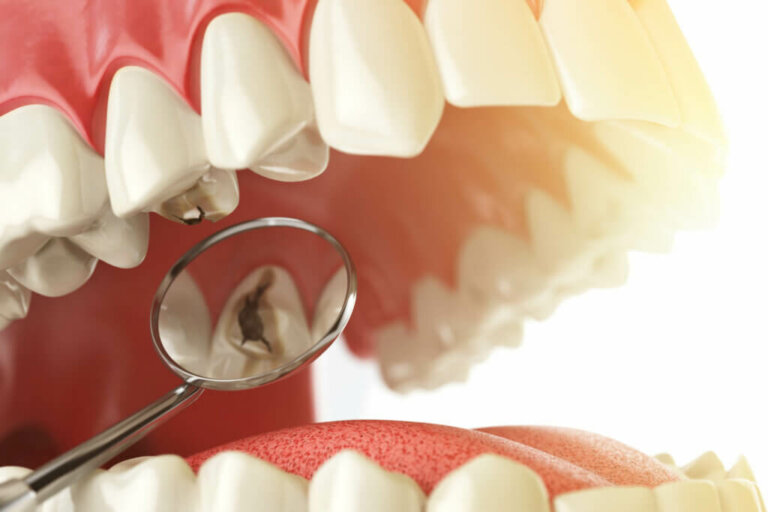 Différences entre les caries et le tartre