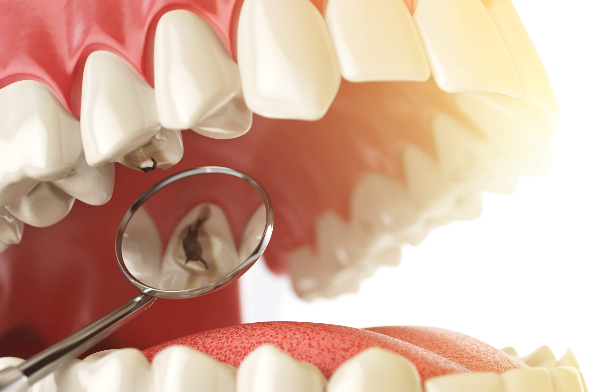 Diferencias entre caries y sarro