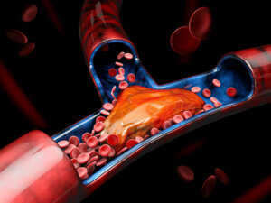 Tromboembolismo pulmonar: lo que debes saber