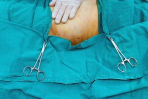 O que é uma lipoescultura?