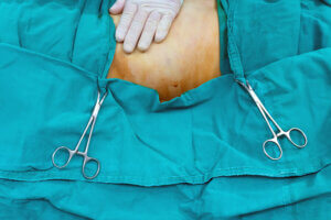 ¿Qué es una lipoescultura?