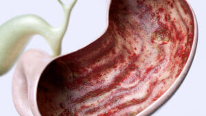 Los 7 tipos de gastritis