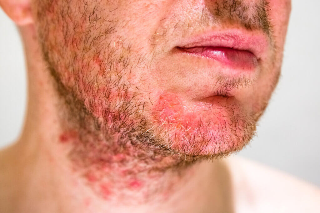 Los tipos de infecciones de la piel incluyen las bacterianas