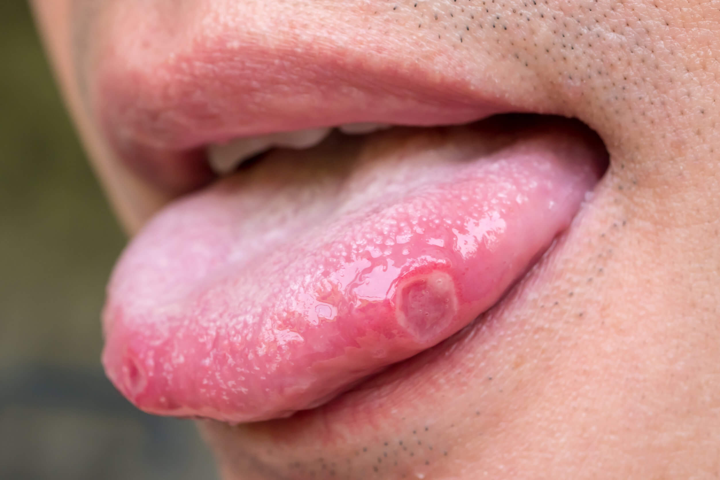 Las 4 enfermedades más comunes de la lengua