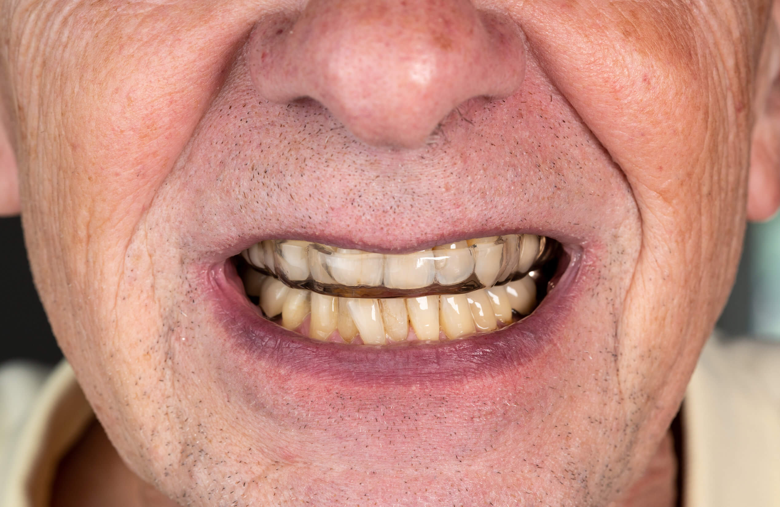 7 causas de los dientes manchados