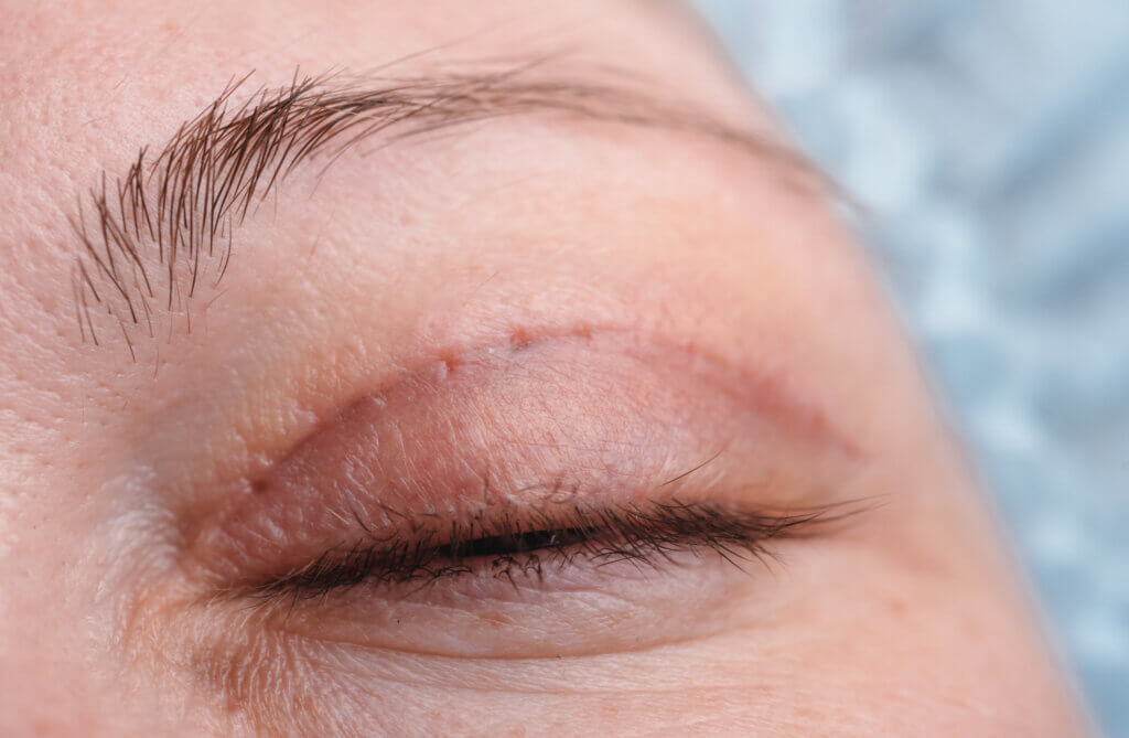 La blefaroplastia es un procedimiento quirúrgico