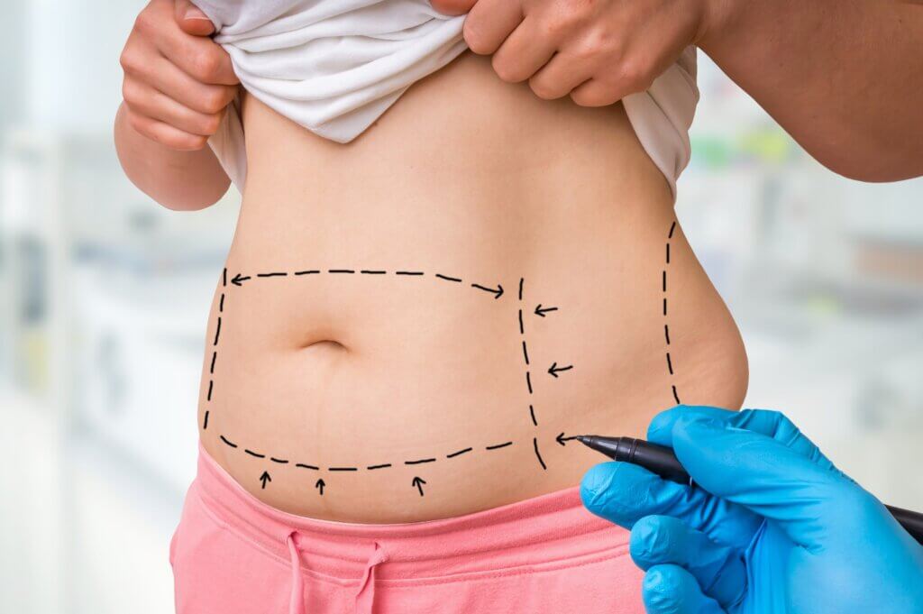 The mommy makeover includes a tummy tuck.
