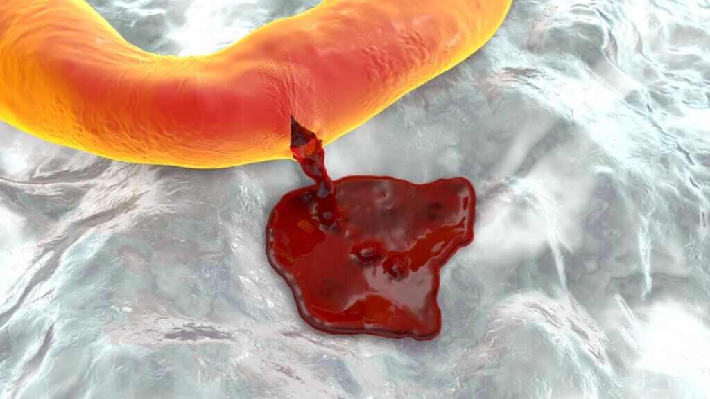 Los peligros de la sobredosis de vitamina incluyen la hemorragia