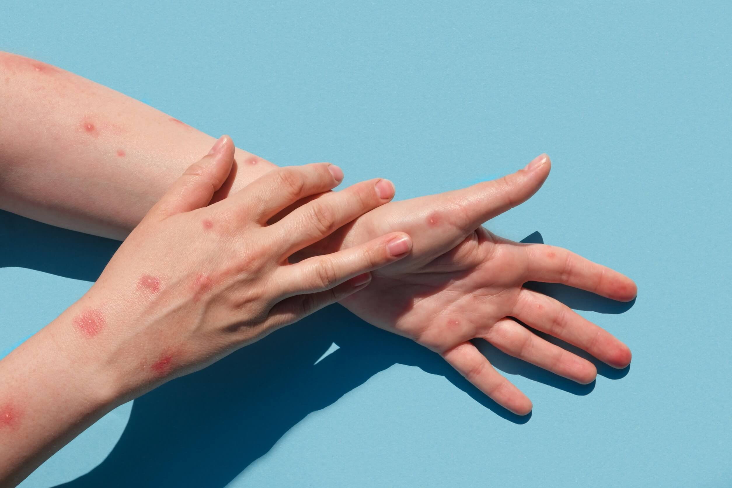 Diferencias entre la neurofibromatosis y la viruela del mono