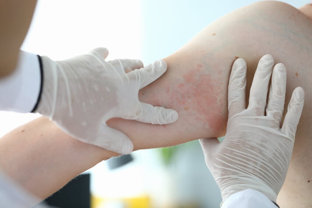 El eczema ótico se asocia a otras enfermedades
