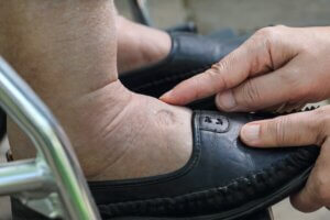 7 causas de los tobillos hinchados y cómo tratarlos