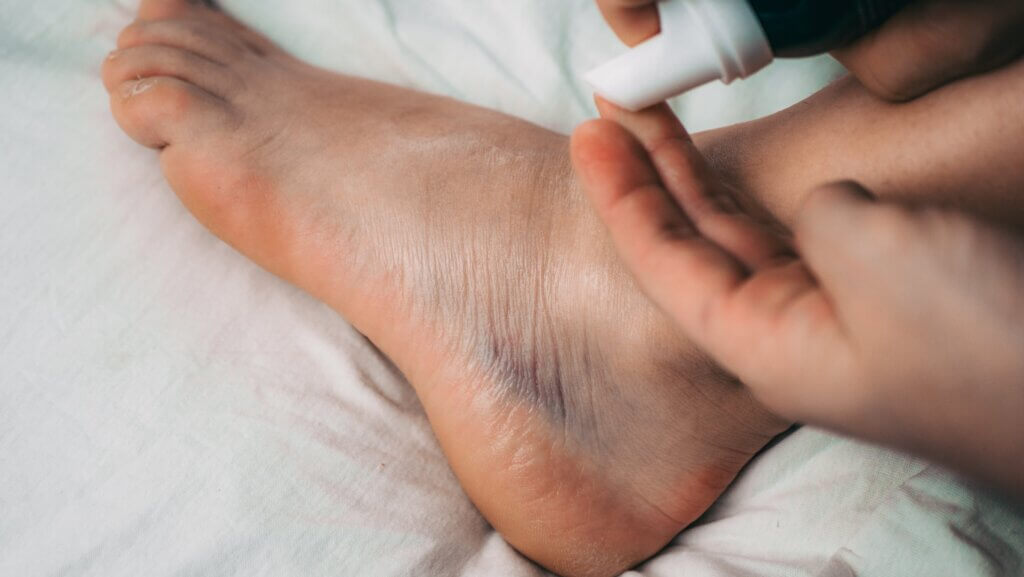 Las causas de los tobillos hinchados incluyen los esguinces