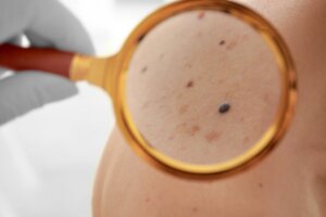 Tipos de lunares y cómo diferenciarlos