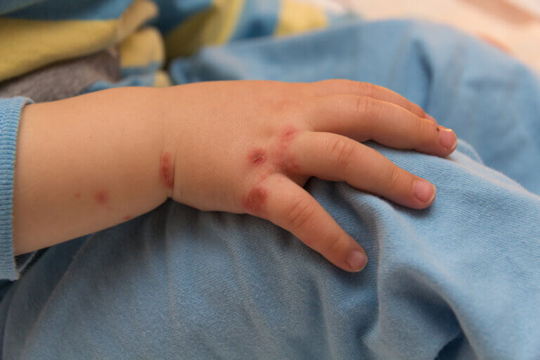 7 claves para prevenir infecciones en la piel de los niños