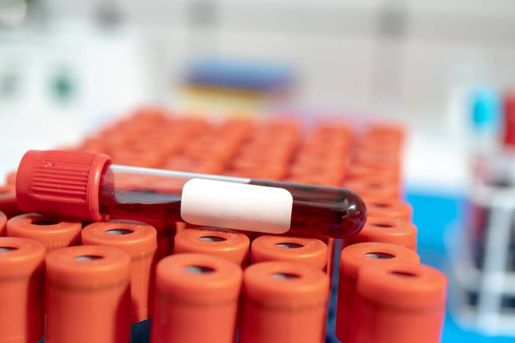 Diabetes type 3C heeft verschillende diagnostische methoden