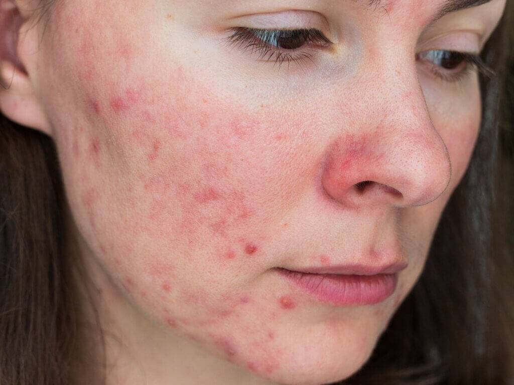 Une femme avec de l'acné sur le visage. 