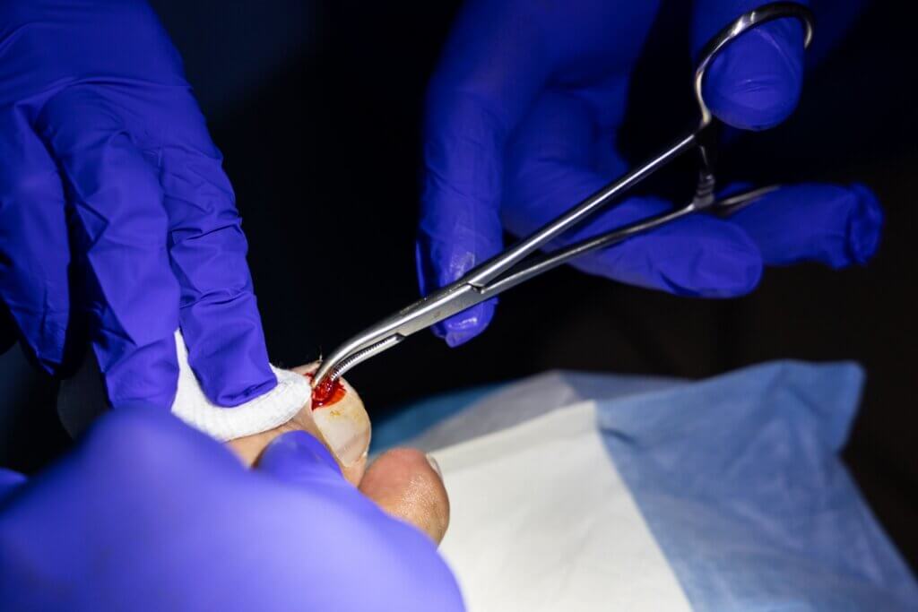 An ingrown toenail being treated.