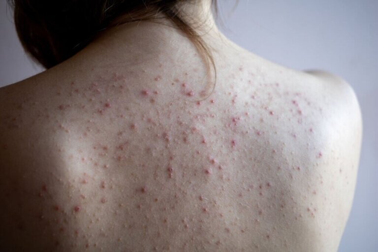 Quelles sont les causes des points rouges sur la peau?