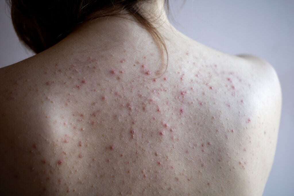 Points rouges sur la peau : pourquoi apparaissent-ils ?