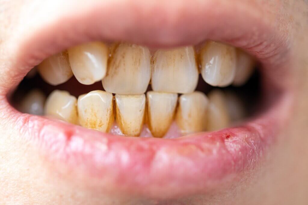 Le rince-bouche quotidien fonctionne pour la plaque bactérienne.