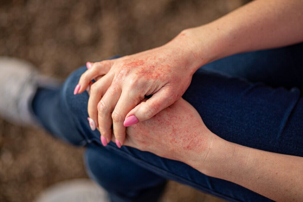 The effects of smoking on the skin include psoriasis.