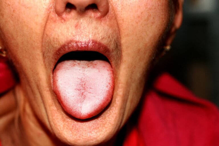 Wat is spruw of orale candidiasis?
