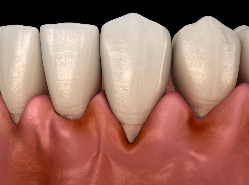 Veel voorkomende tandvleesaandoeningen zijn gingivitis
