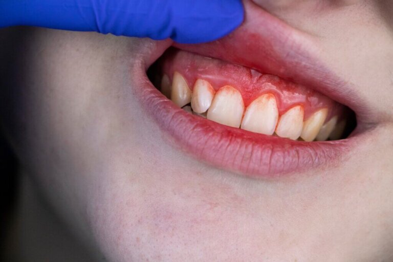 De 4 meest voorkomende tandvleesaandoeningen