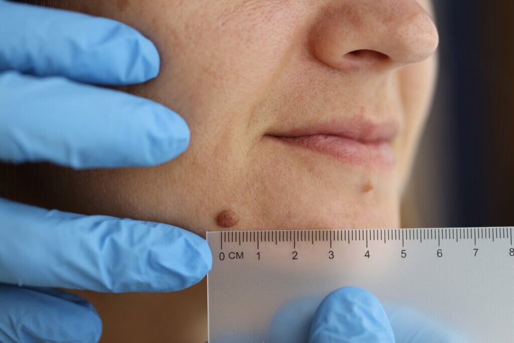 Une taupe dangereuse augmente beaucoup de taille