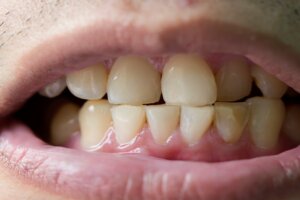 Dientes amarillos: posibles causas y tratamiento