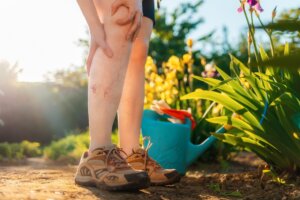 Diferencias entre arañas vasculares y varices