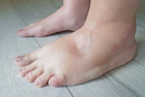 Edema: causas, tipos, sintomas e tratamentos