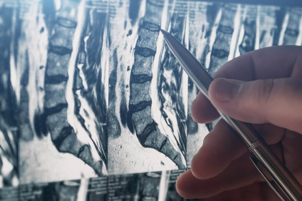 Las enfermedades y los dolor de lumbares incluyen la hernia discal