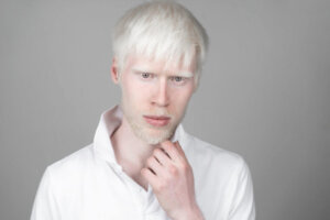 O que é albinismo?