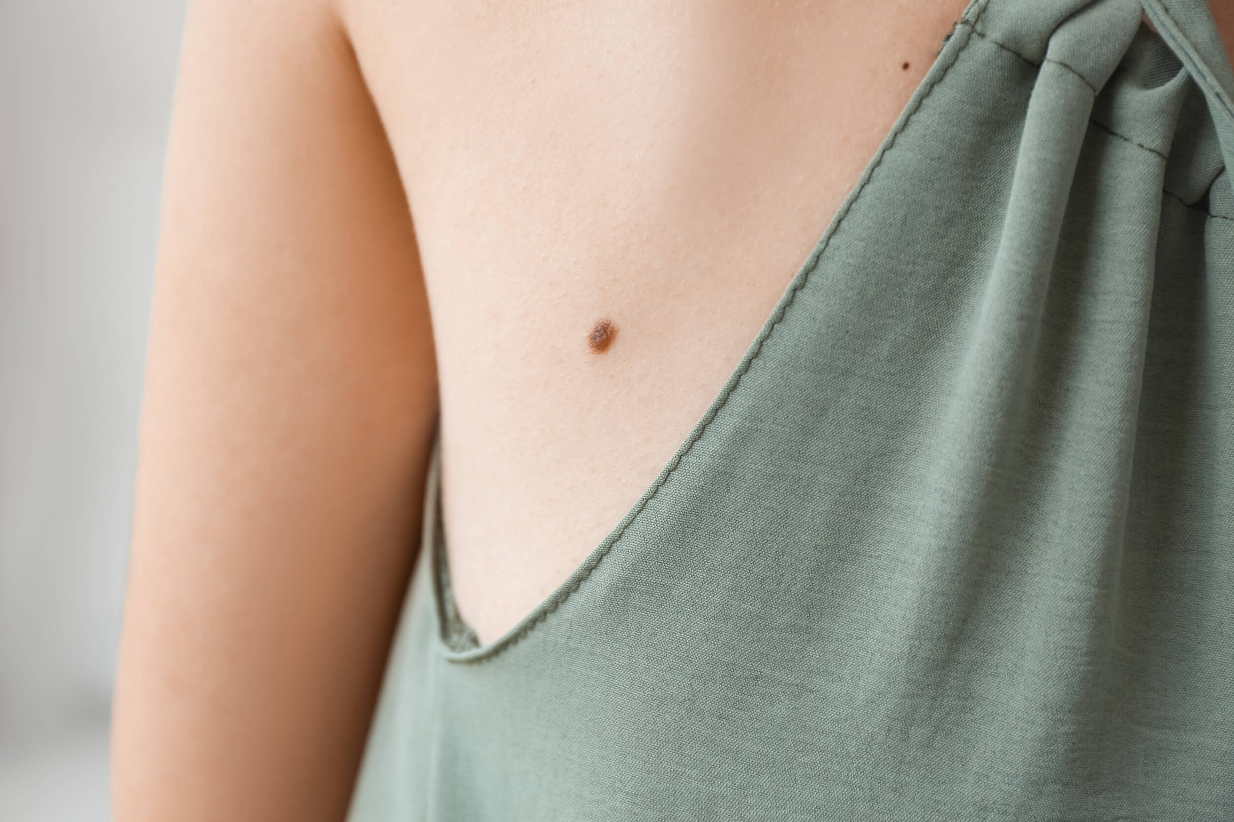 Cómo saber si un lunar es peligroso