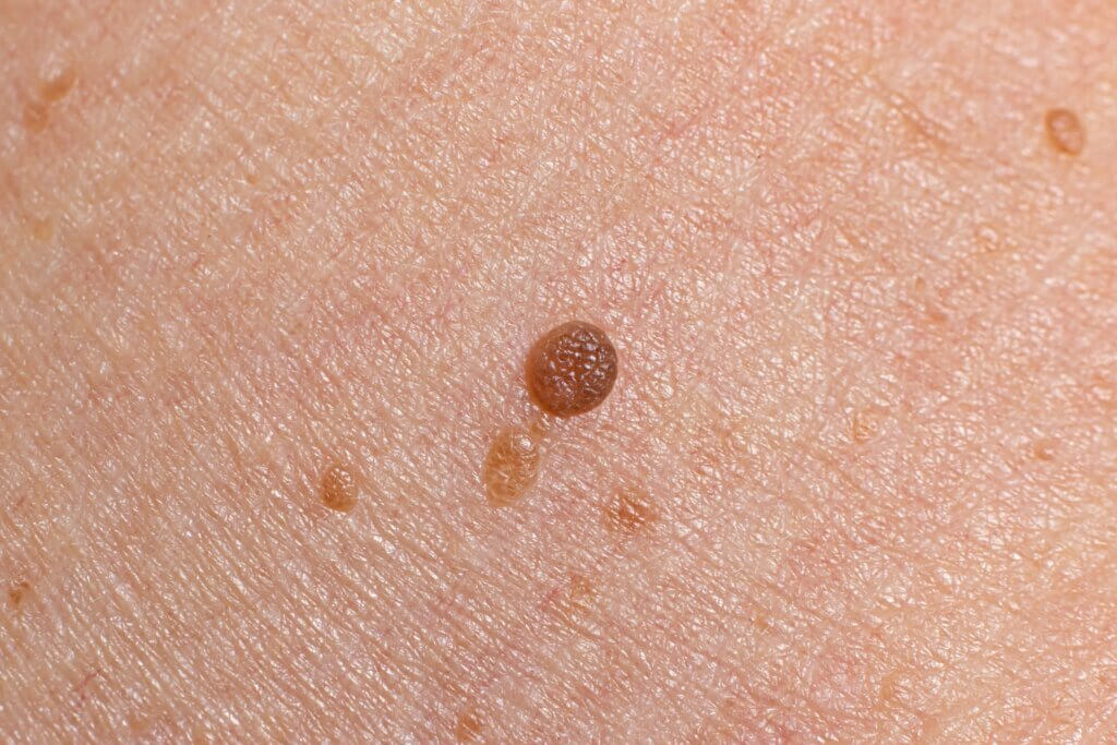 A dangerous mole has texture changes.