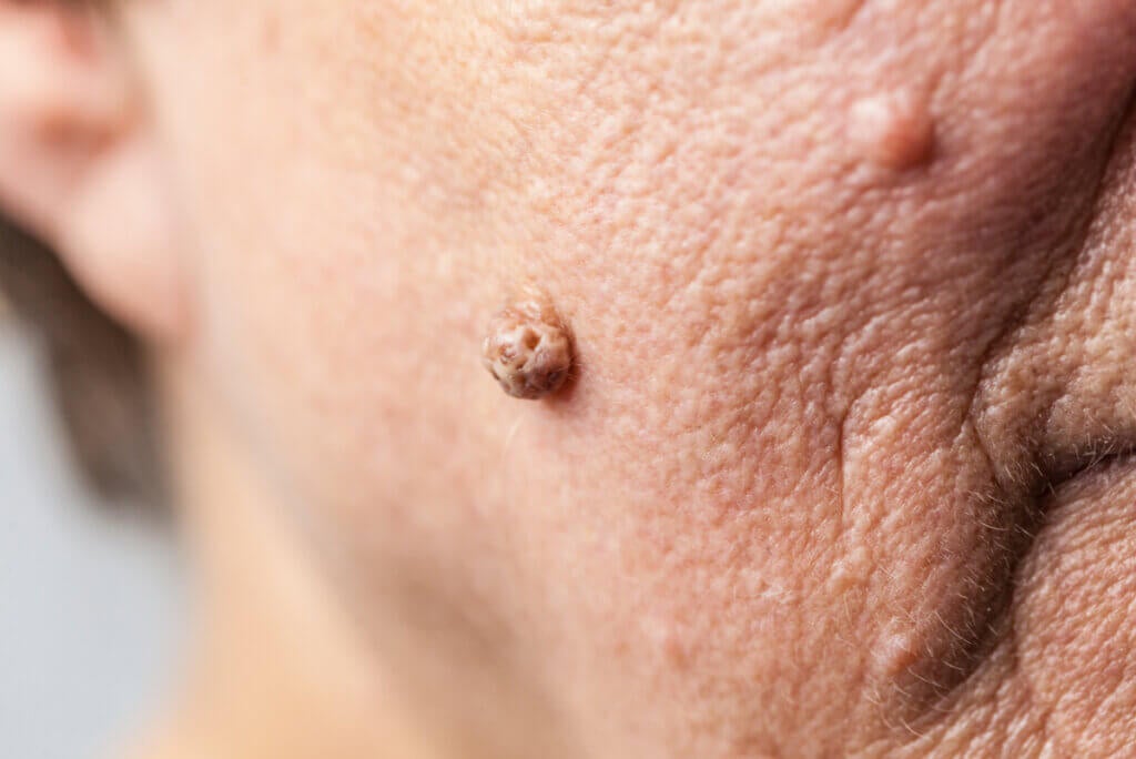Types of Warts, Characteristics, and How to Remove Them
