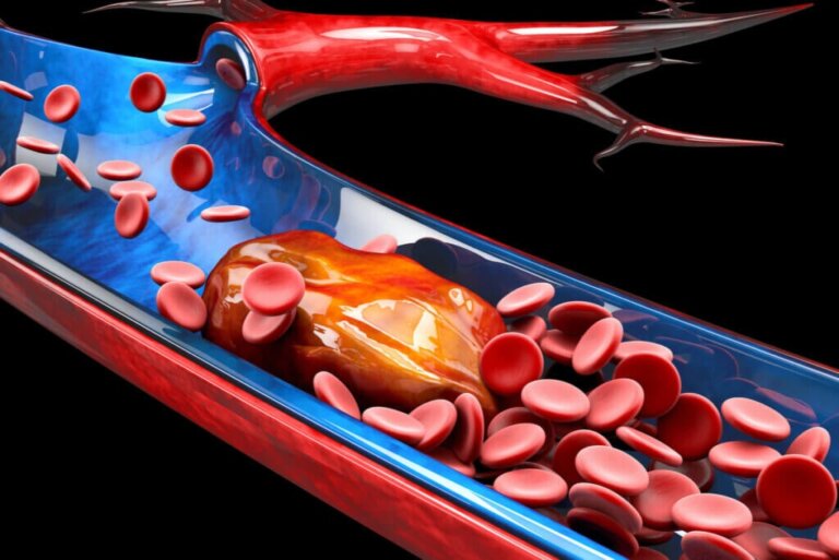 Sintrom: What Is It and What Is It For?