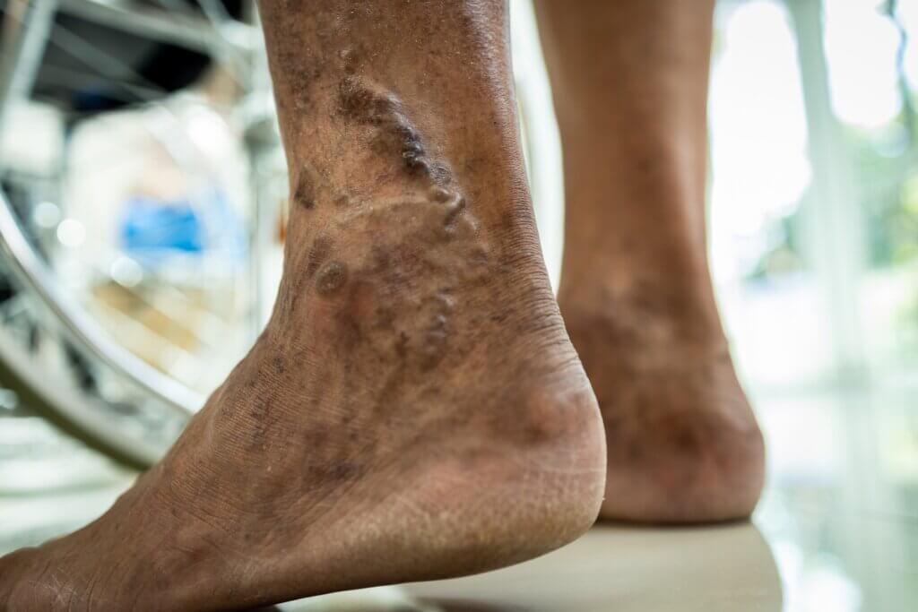 Las diferencias entre arañas vasculares y varices incluyen el dolor