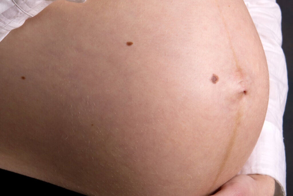 La linea alba pendant la grossesse : quelles sont les causes?
